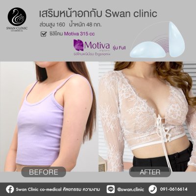 รีวิวศัลยกรรมหน้าอก