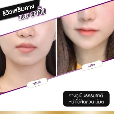 รีวิวศัลยกรรมปาก