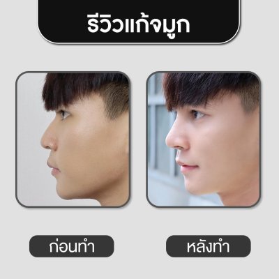 รีวิวศัลยกรรมจมูก