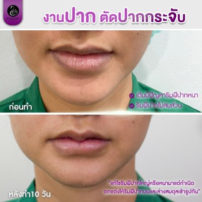รีวิวศัลยกรรมปาก