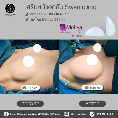 รีวิวศัลยกรรมหน้าอก