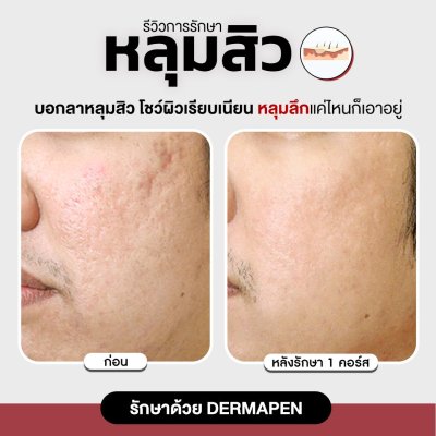 รีวิวรักษาหลุมสิว