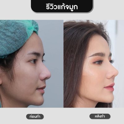 รีวิวศัลยกรรมจมูก