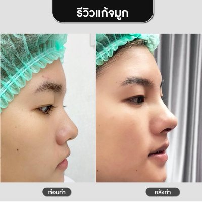 รีวิวศัลยกรรมจมูก