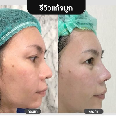 รีวิวศัลยกรรมจมูก