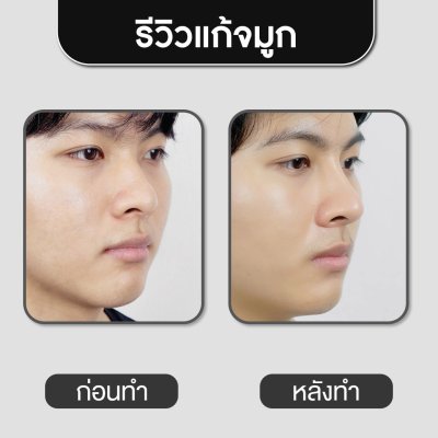 รีวิวศัลยกรรมจมูก