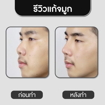 รีวิวศัลยกรรมจมูก