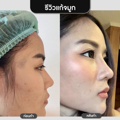 รีวิวศัลยกรรมจมูก