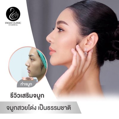 รีวิวศัลยกรรมจมูก