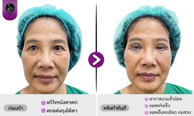 รีวิวศัลยกรรมตา