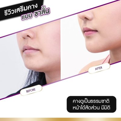 รีวิวศัลยกรรมคาง