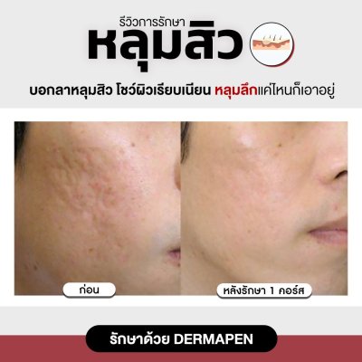 รีวิวรักษาหลุมสิว