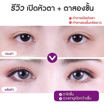 รีวิวศัลยกรรมตา