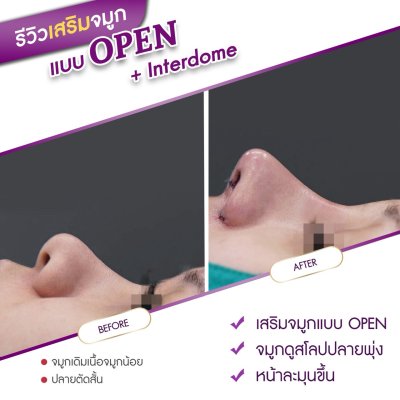 รีวิวศัลยกรรมจมูก