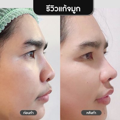 รีวิวศัลยกรรมจมูก