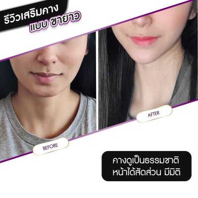 รีวิวศัลยกรรมคาง