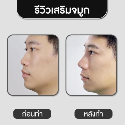 รีวิวศัลยกรรมจมูก