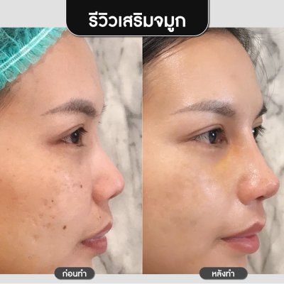 รีวิวศัลยกรรมจมูก