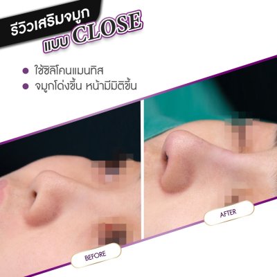 รีวิวศัลยกรรมจมูก