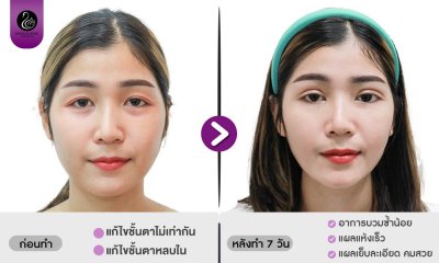 รีวิวศัลยกรรมตา