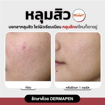 รีวิวรักษาหลุมสิว