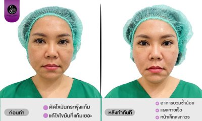รีวิวตัดไขมันกระพุ้งแก้ม