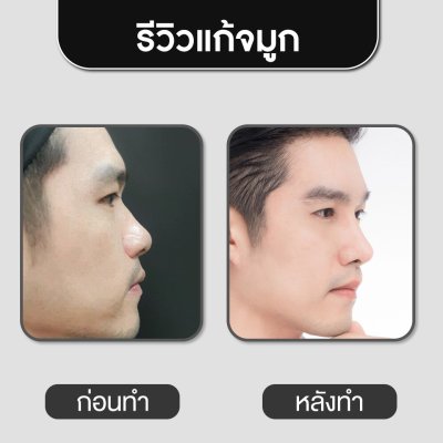 รีวิวศัลยกรรมจมูก