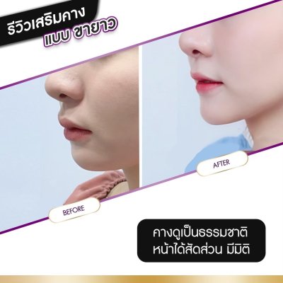 รีวิวศัลยกรรมคาง
