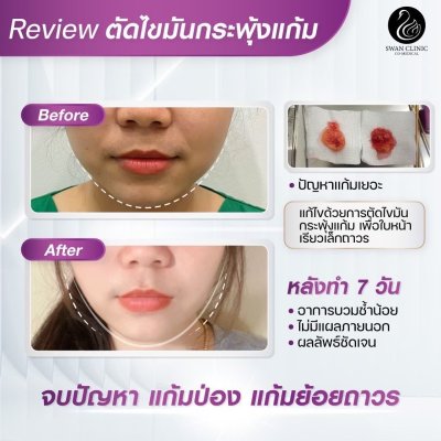 รีวิวตัดไขมันกระพุ้งแก้ม