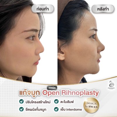 รีวิวศัลยกรรมจมูก