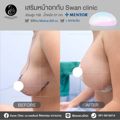รีวิวศัลยกรรมหน้าอก