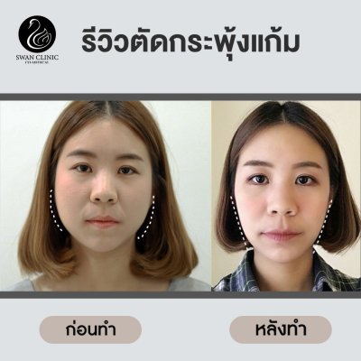 รีวิวตัดไขมันกระพุ้งแก้ม