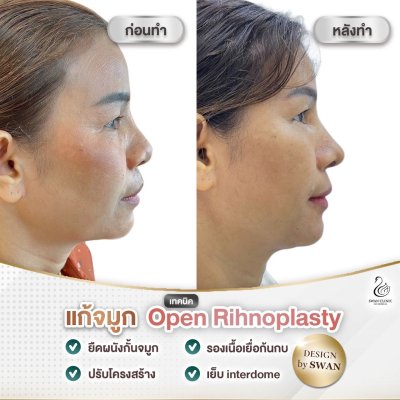 รีวิวศัลยกรรมจมูก