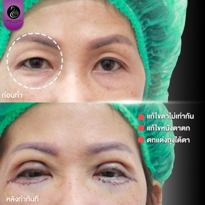 รีวิวศัลยกรรมตา