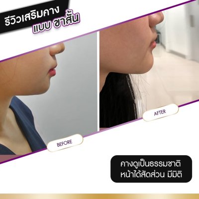 รีวิวศัลยกรรมคาง