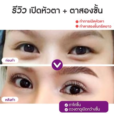 รีวิวศัลยกรรมตา