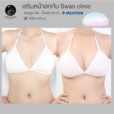 รีวิวศัลยกรรมหน้าอก