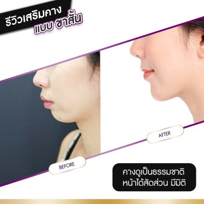 รีวิวศัลยกรรมคาง