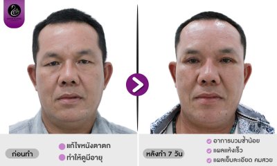 รีวิวศัลยกรรมตา
