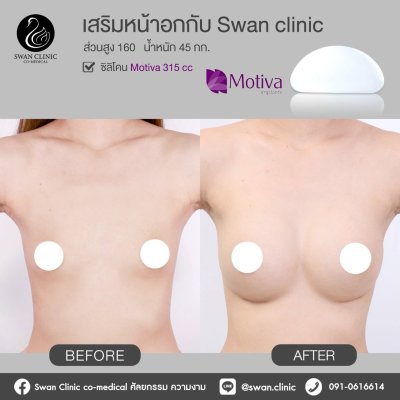 รีวิวศัลยกรรมหน้าอก