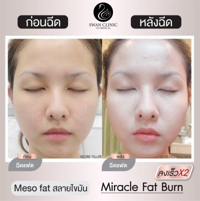 ฉีดแฟต