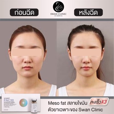 ฉีดแฟต