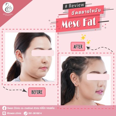 ฉีดแฟต