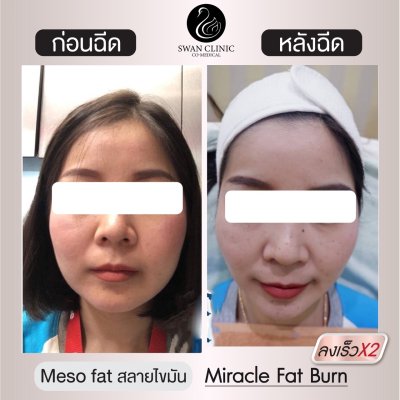 ฉีดแฟต