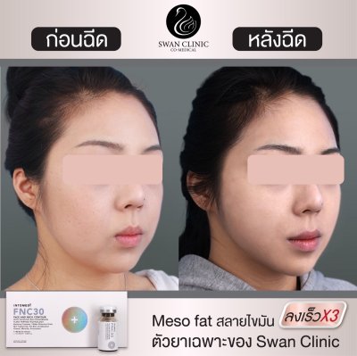 รีวิวฉีดแฟต