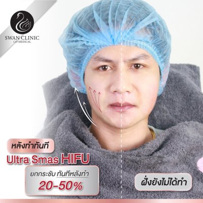Hifu
