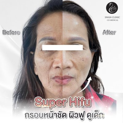 Hifu