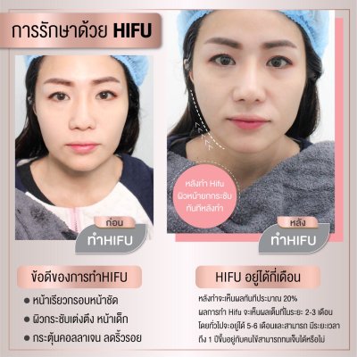 Hifu