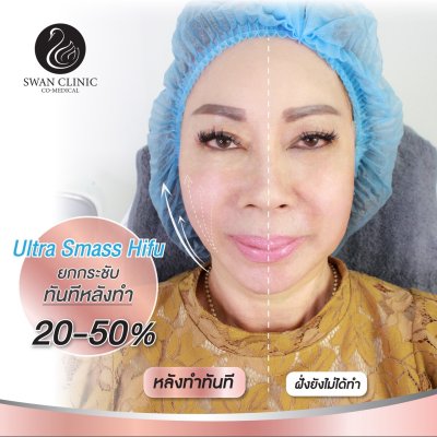 รีวิว Hifu