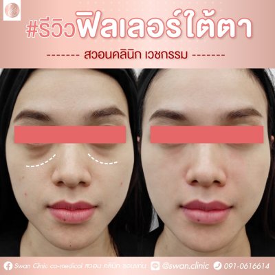 ฟิลเลอร์ใต้ตา